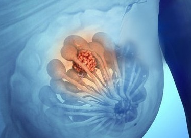 乳腺增生是一种什么病,严重吗
