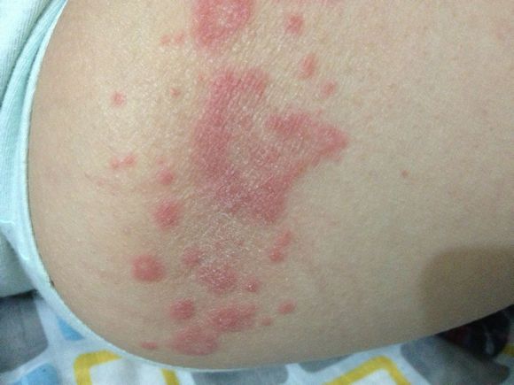 亚急性皮肤型红斑狼疮(scle),是一种介于盘状红斑狼疮和系统性红斑